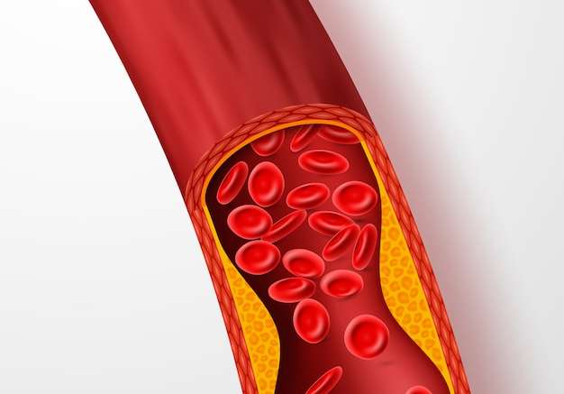 Hình vẽ vector Tắc nghẽn mạch máu, động mạch có huyết khối cholesterol. tĩnh mạch 3d với hình minh họa vector cục máu đông