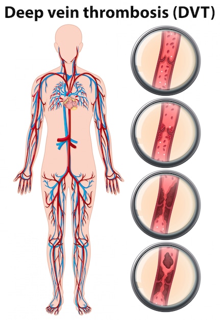 Hình vector Giải phẫu huyết khối tĩnh mạch sâu