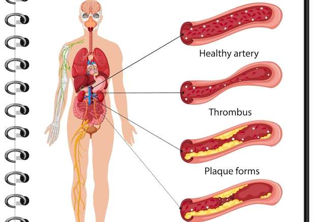 Hình vector Infographic thông tin về các giai đoạn của xơ vữa động mạch