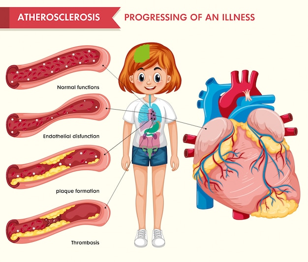 Hình vector Infographic y tế khoa học về xơ vữa động mạch
