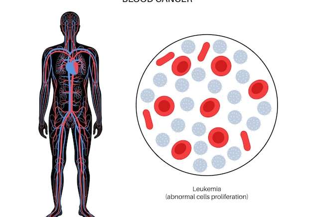 Hình vector Mẫu vật mắc bệnh bạch cầu. khái niệm ung thư máu hệ thống tuần hoàn của con người, giải phẫu tế bào máu