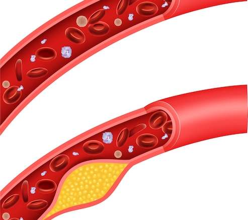 Hình vector Minh họa động mạch chặn cholesterol