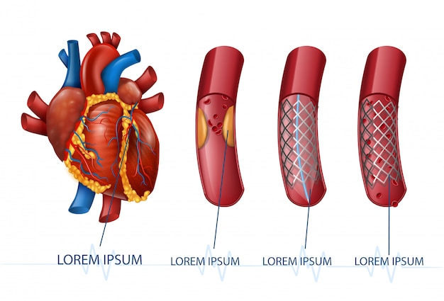 Hình vector nhồi máu cơ tim