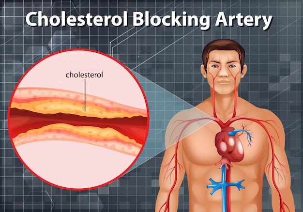 Hình vector Sơ đồ cho thấy cholesterol chặn động mạch trong cơ thể con người