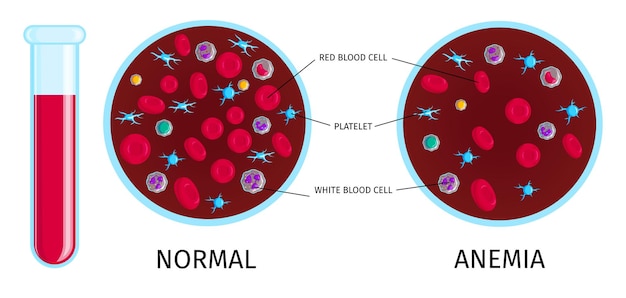 Hình vector Xét nghiệm máu với infographic thiếu máu