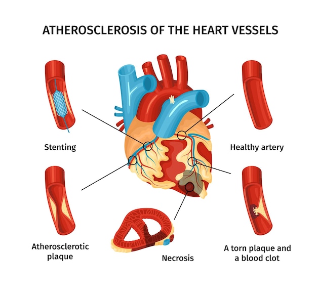 Hình vector Xơ vữa động mạch tim đồ họa thông tin phẳng với các bộ phận được dán nhãn